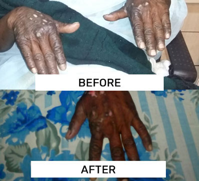 Case of Psoriasis	