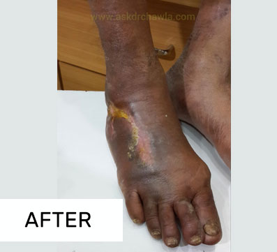 Case of Gangrene 