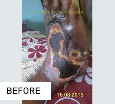 Case of Gangrene 